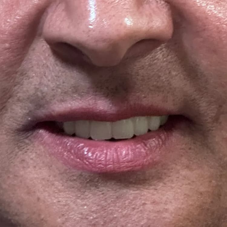 Before Complete Smile Makeover with Veneers