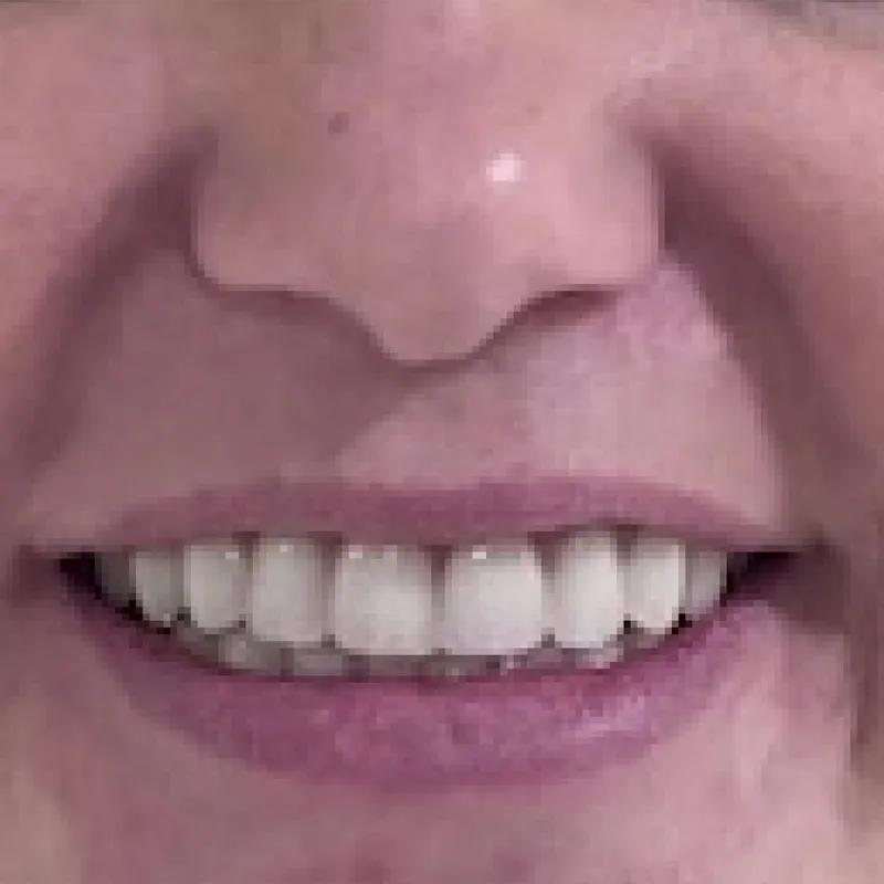 Before Full Mouth Reconstruction