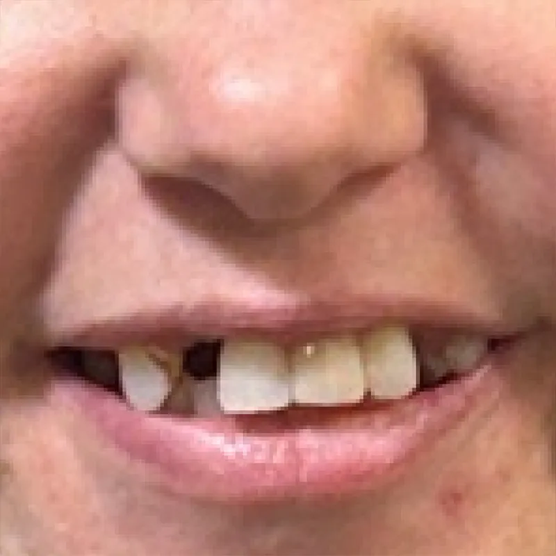 After Full Mouth Reconstruction