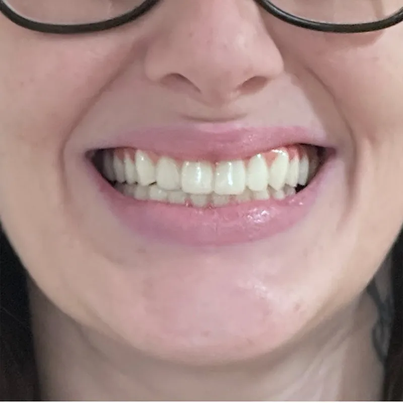 Before Dental Implant Restoration