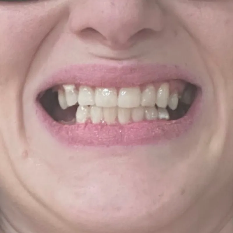 After Dental Implant Restoration