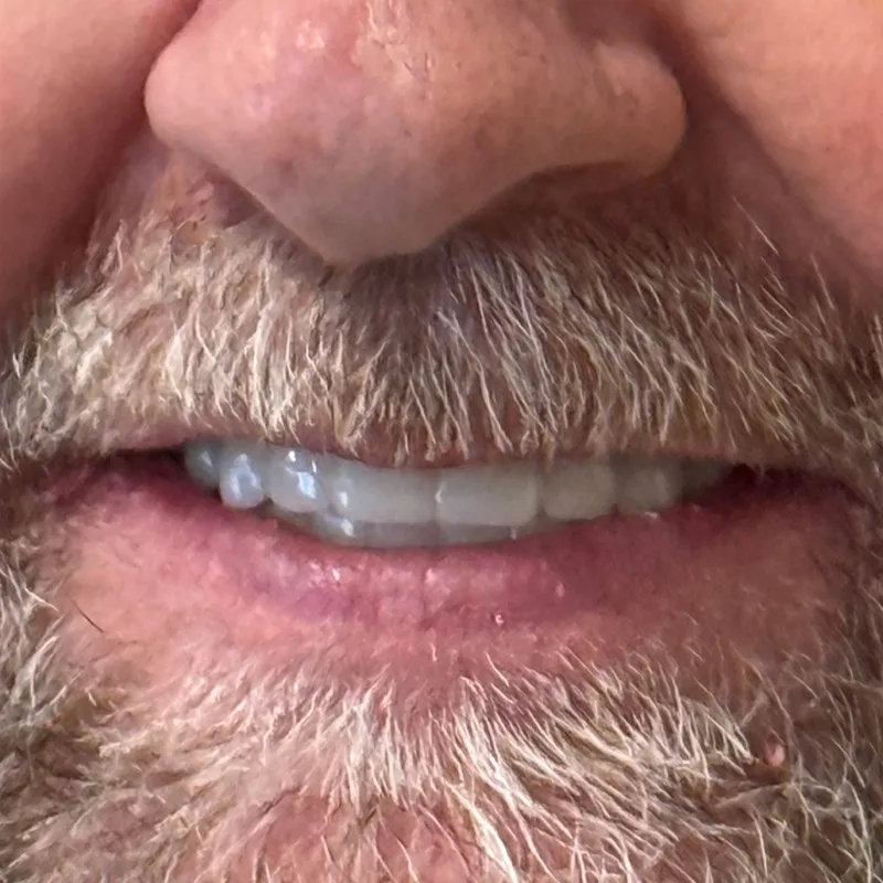 Before Teeth Whitening & Composite Bonding