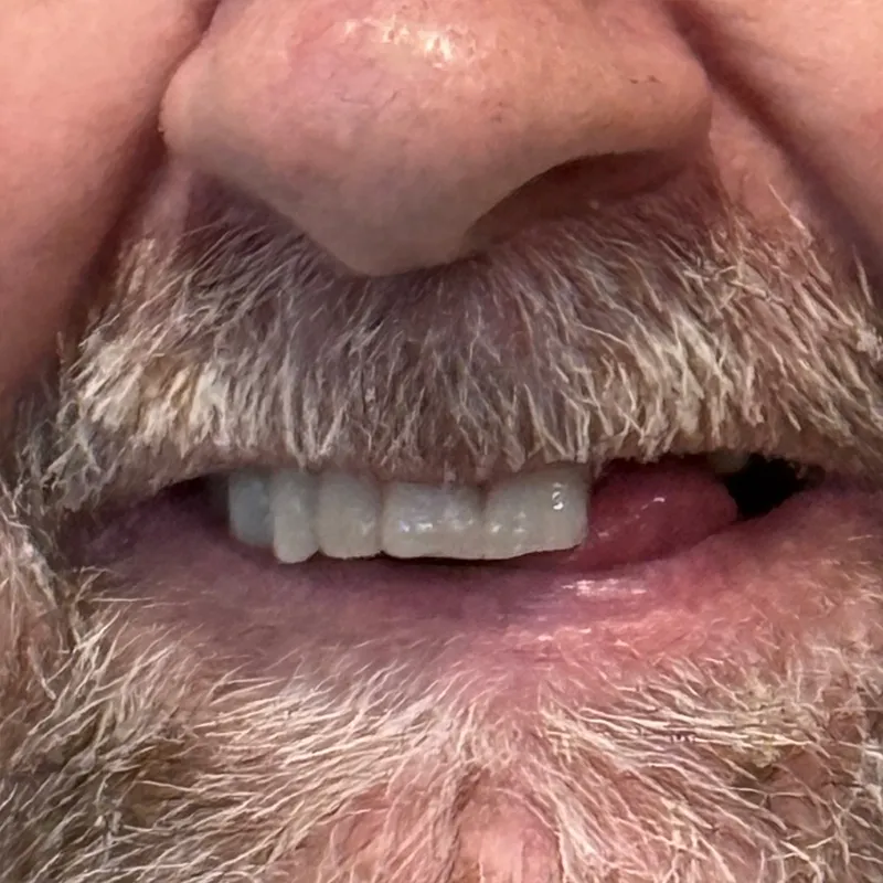 After Teeth Whitening & Composite Bonding