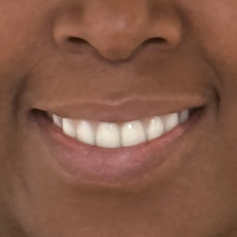 Before Crown Lengthening & Veneers