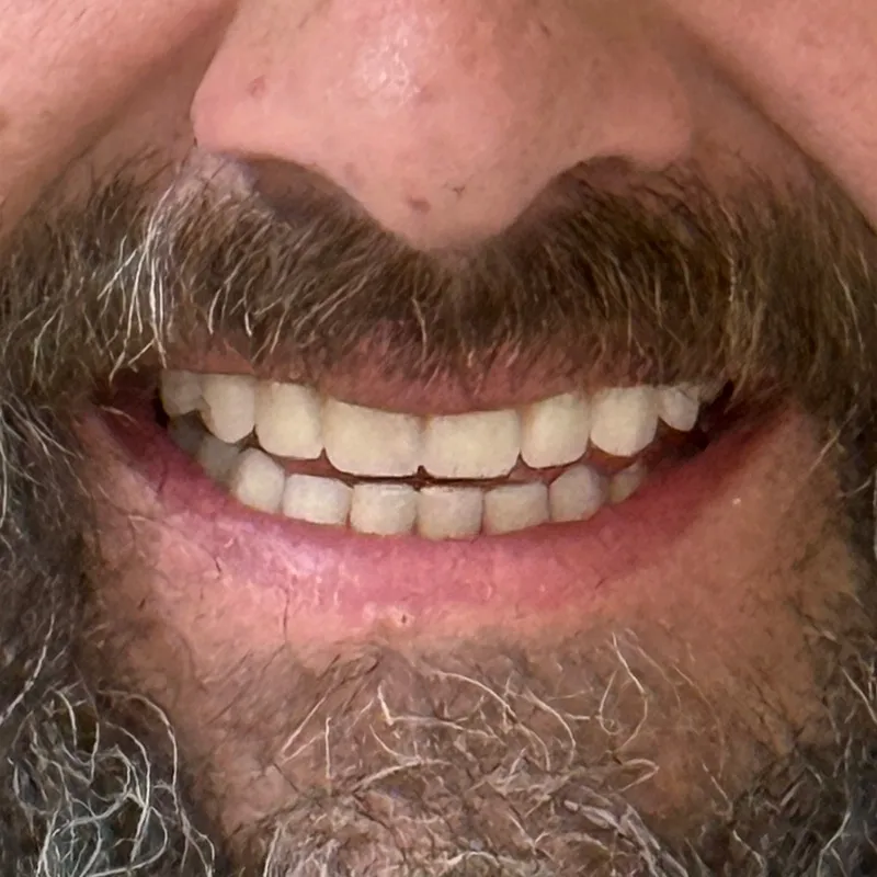 Before Complete Denture Transformation