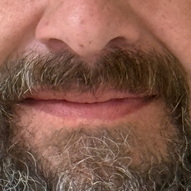 After Complete Denture Transformation