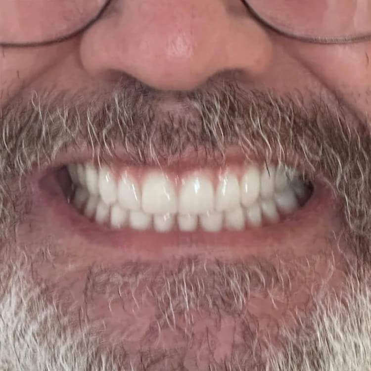 Before Cosmetic Crown Replacement